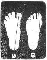 Kineziterapija pėdoms. Geriausi gydymo būdai: pėdų gydymas mankšta pratimais
