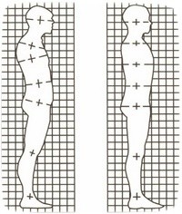 Kaip vystosi skoliozė - stuburo skoliotinė deformacija