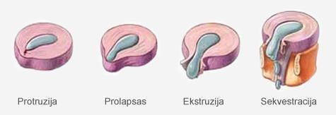 Stuburo išvarža – labai dažna diagnozė. Kokie išvaržos simptomai?