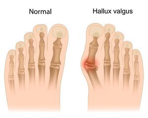skauda peda pedu skausmas hallux valgus operacijos pedos manksta pratimai pedoms